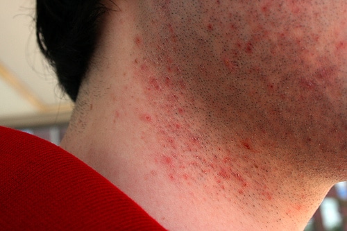 Severe Shaving Rash