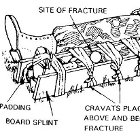 Save Lives Like a Combat Medic: How to Splint a Lower-Leg Fracture