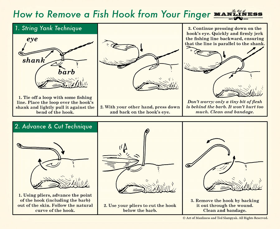 String yank technique frame 1: Tie off a loop with some fishing line. Place the loop over the hook's shank and lightly pull it against the bend of the hook. Frame 2: With your other hand, press down and back on the hook's eye. Frame 3: Continue pressing down on the hook's eye. Quickly and firmly jerk the fishing line backward, ensuring that the line is parallel to the shank. Don't worry: only a tiny bit of flesh is behind the barb. It won't hurt too much. Clean and bandage. Advance & cut technique frame 1: Using pliers, advance the point of the hook (including the barb) out of the skin. Follow the natural curve of the hook. Frame 2: Use your pliers to cut the hook below the barb. Frame 3: Remove the hook by backing it out through the wound. Clean and bandage. 