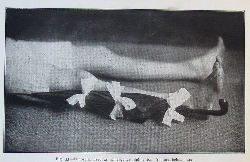 umbrella vintage man with umbrella splint broken leg