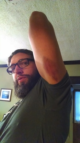 man with bruise on arm from home garage fight club 