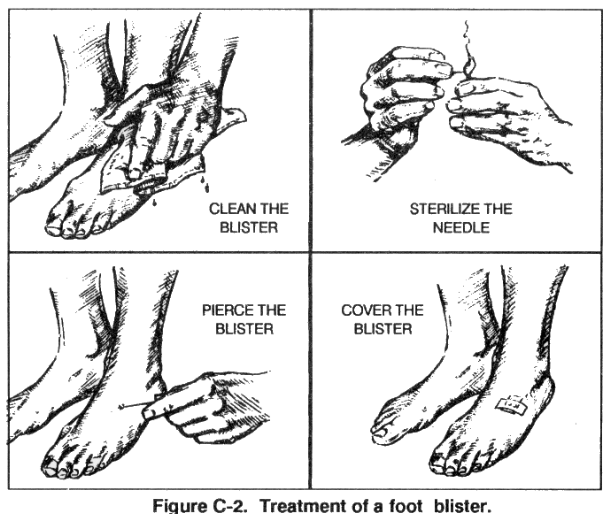 How to treat foot blister illustration.