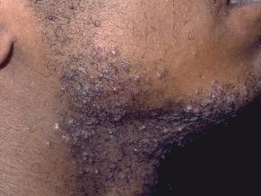 Razor bumps on black American black men's face after shaving.