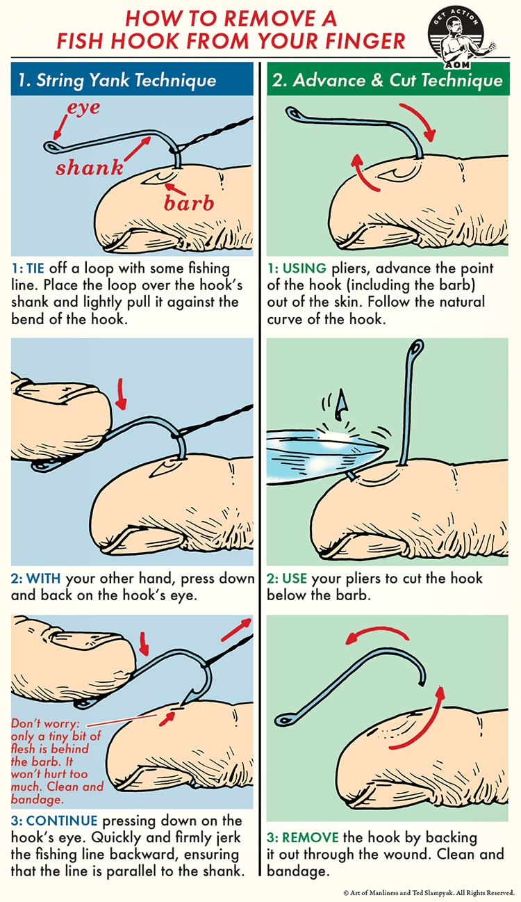 How to Remove a Fish Hook