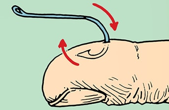Illustration showing the removal of a fish hook from a finger using a two-step push-and-pull method.