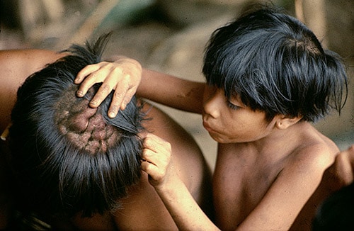 A child seeing a fighting scars on top of head. 