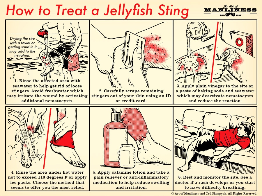 How to treat a jellyfish sting illustration.