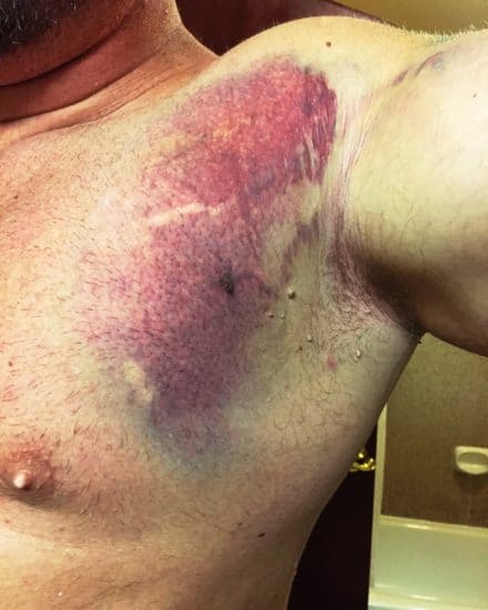 Torn pec pectoral muscle bruise on chest and armpit.