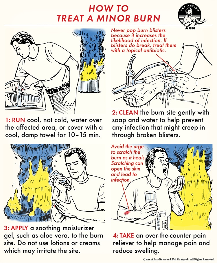 Illustrated first aid instructions for minor burn treatment.