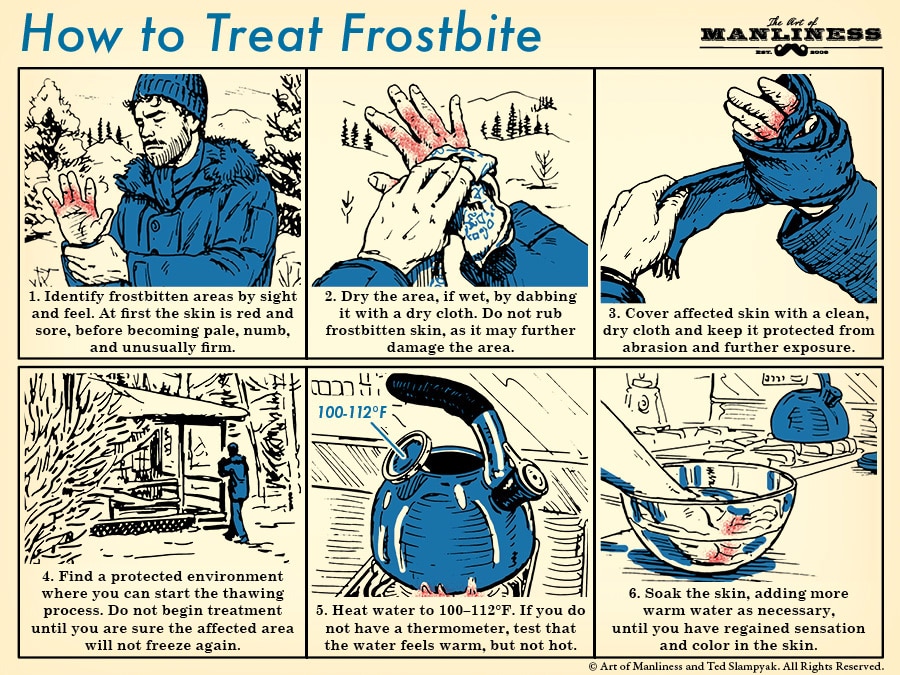 How to treat frostbite illustration diagram.