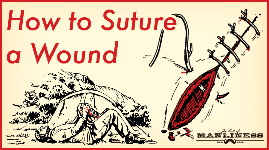 Illustration of how to suture a wound.