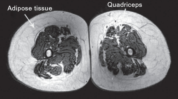 MRI scan of 74-Year-Old sedentary Man.