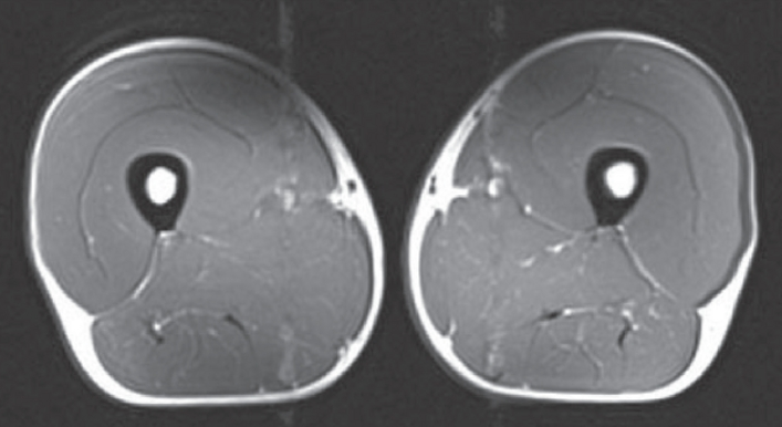 MRI scan of forty Year old triathlete. 