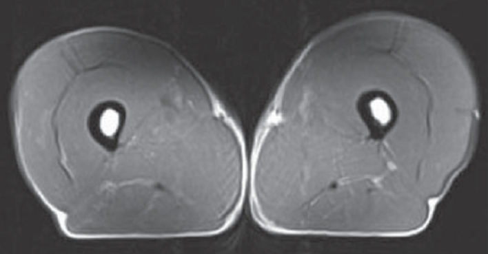 MRI scan of 70-Year-Old Triathlete.