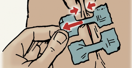 A person is using an improvised method to close a wound on another person's stomach.