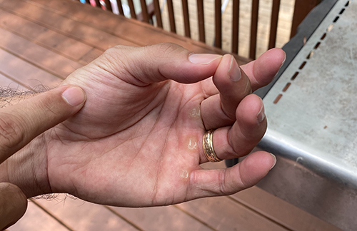 Hand testing for medium rare steak.