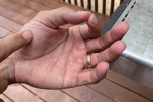 A man testing his hand for rare steak.