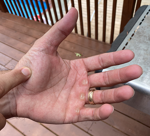 A man testing his hand for steak doneness.