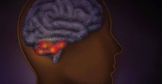 Illustration of a human head in profile with a visible brain, highlighting an area of inflammation or disease in the frontal lobe related to brain aging.